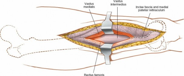 Illustration 30 for Optimal Femoral Approaches: Mastering the Lateral Intermuscular Septum