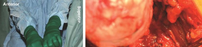 Illustration 48 for Birmingham Hip Resurfacing Designer's Technique for Active Lives