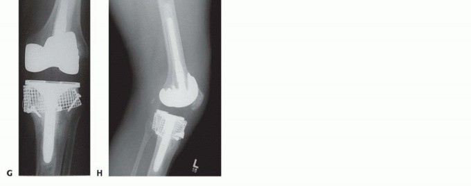 Illustration 11 for Bone Loss Bone Grafting for Challenging Tibial Defects