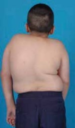 Thoracoscopic Fusion: Treating Scoliosis & Neural Axis Abnormalities