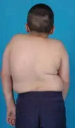 الجنف والحل الشافي: دليل شامل لجراحة الانصهار بالمنظار الفقاري - مع الدكتور محمد هطيف