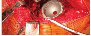 Illustration 16 for Uncemented Acetabular Revision: Optimizing Hemispherical Cup Use