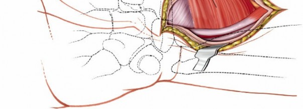 Illustration 9 for Volar Approach: Optimal Exposure for the Volar aspect of the Distal Radius