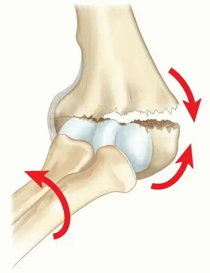 كسور فوق اللقمة في عظم العضد لدى الأطفال: دليل شامل للوالدين مع الأستاذ الدكتور محمد هطيف