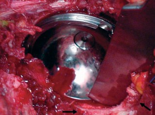 Illustration 35 for Mastering the Cementless Acetabular Cup: Techniques for Optimal Fixation