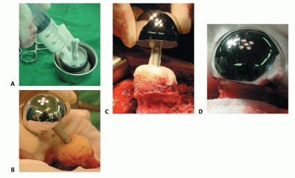 Illustration 11 for Hip Resurfacing: The Bone-Sparing Solution around the Femoral Head