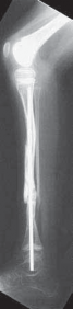 Illustration 22 for Solving Congenital Pseudarthrosis: Tibia with the Williams Rod