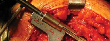 Illustration 18 for S-ROM: Inside the Technique of Modular Implant Design