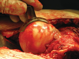 Illustration 31 for Figure Hip Resurfacing: Who Benefits and Who Should Avoid It?