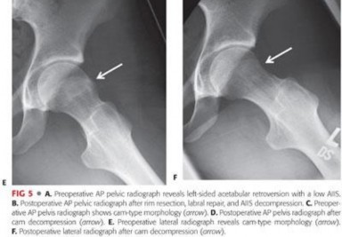 Illustration 200 for Mastering the Scope for Femoroacetabular Impingement