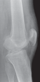 Illustration 2 for Cruciate Ligament Repair: Definitive Guide to Treatment & Recovery