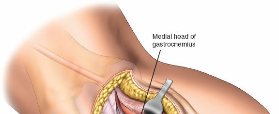 Figure 25: A well-reduced and fixed posterolateral tibial plateau fracture seen on post-operative X-ray.