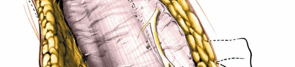 Illustration 25 for Unlocking Every Aspect of the Hip's Surgical Approaches