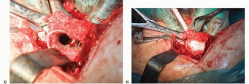 Illustration 34 for Special THA Techniques for Severe Deformities Around the Hip