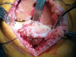 Illustration 10 for Minimally Invasive Subvastus: The Best Path to Quicker TKA Recovery