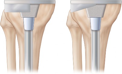 Illustration 3 for Understand Augments: The Role of Metal Augments in Arthroplasty