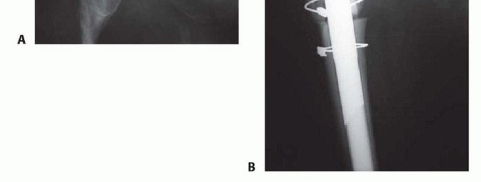 Illustration 10 for Overcoming Proximal Femoral Bone Loss: Fluted Stems in Revision THA