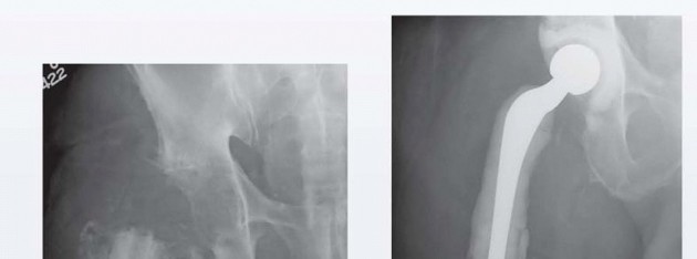Illustration 15 for Resection Arthroplasty & Spacers: Optimizing Time of Reimplantation