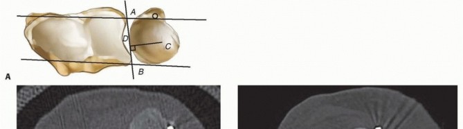 Illustration 7 for Galeazzi DRUJ Stabilization: Unlocking Stability with Smooth Stainless Steel