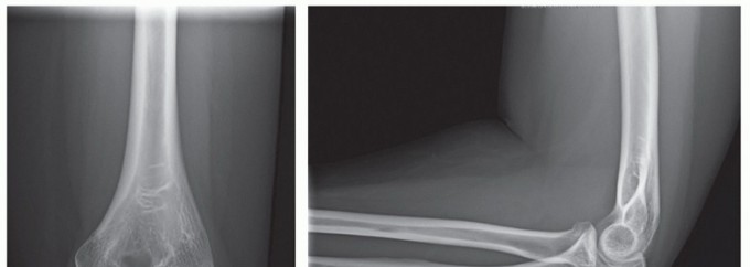 Illustration 44 for Radial Head & Neck Fractures: Mastering ORIF for Best Results