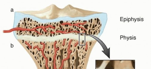 Physeal Bar Resection: How to Correct Growth Plate Problems