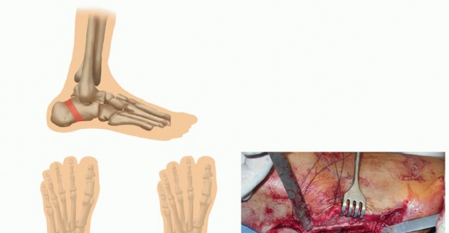 Illustration 35 for How Achilles Tendon Lengthening Fixes Equinocavovarus Foot