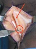 Illustration 18 for Unlocking Mobility: Distal Lengthening for Lateral Hamstring Muscle