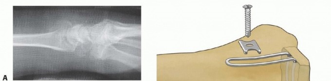 Illustration 43 for Fragment-Specific Fixation: Restore Carpal Facet Horizon