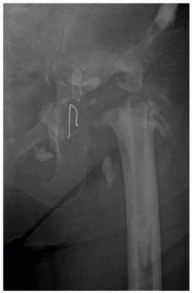 Illustration 6 for Uncemented Acetabular Revision: Optimizing Hemispherical Cup Use