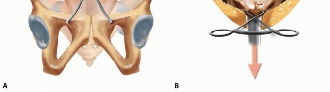 Illustration 14 for Achieve Stable Fixation of the Symphysis: Open Reduction