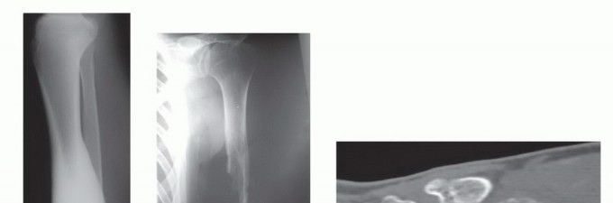 Illustration 8 for Free Vascularized Fibular Grafts: Solving Complex Bone Defects