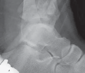 Illustration 34 for Optimizing ORIF for Tibial Plafond Fractures: A Modern Approach
