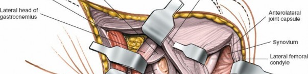 Illustration 153 for Mastering Knee Approaches: Spotlight on Superficial Medial Ligament