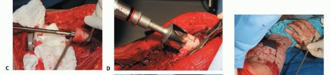 Illustration 43 for Advanced Distal Femoral Resections: Limb-Sparing Outcomes & Techniques