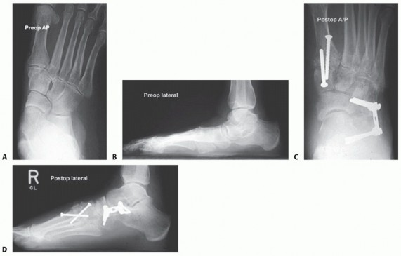 Illustration 24 for Lateral Column Lengthening: Relieve Flatfoot Pain & Correct Deformity