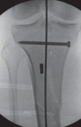 Illustration 55 for Optimal Nailing of the Tibia: Techniques for Challenging Fractures