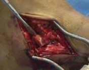 Illustration 36 for Talar Neck Fracture Treatment: Optimizing Recovery with ORIF