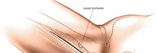 Illustration 210 for Unlocking Every Aspect of the Hip's Surgical Approaches