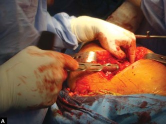 Illustration 47 for The Silent Hip: Achieving a Truly Silent, Pain-Free Joint