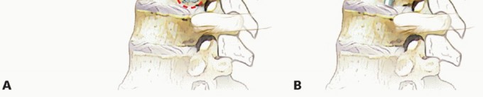 Illustration 12 for Anterior Thoracic Corpectomy: Decompression, Stabilization, Fusion