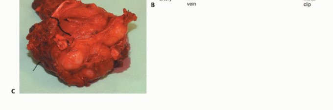 Illustration 17 for Optimizing Adductor Muscle Group Resection for Limb Preservation