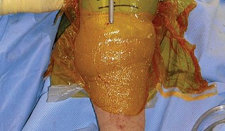 Illustration 15 for Optimize Tibial Component Alignment: Techniques for TKA Success