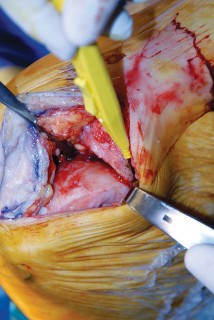 صورة طبية: جراحة استبدال مفصل الركبة الجزئي (UKA): تجنب الأخطاء والاستفادة القصوى في صنعاء مع الأستاذ الدكتور محمد هطيف