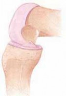 Illustration 45 for Optimizing Single-Bundle Anterior Cruciate Ligament Repair