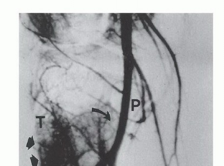 Illustration 11 for Tackling Complex Tumors of the Proximal Tibia: Limb-Sparing Solutions