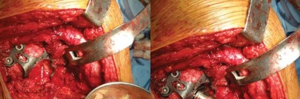 Illustration 33 for Optimizing Arthroplasty in Acute Fractures: Octopus System