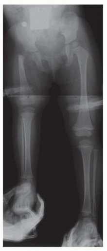 Illustration 7 for Treatment for Congenital Femoral Deficiency: What You Need to Know