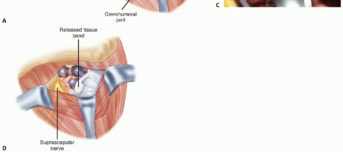Illustration 19 for Decompressing the Transverse Scapular Ligament for Shoulder Pain Relief