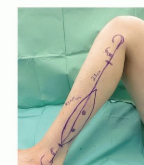 Illustration 25 for Free Vascularized Fibular Grafts: Solving Complex Bone Defects