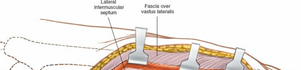 Illustration 22 for Optimal Femoral Approaches: Mastering the Lateral Intermuscular Septum